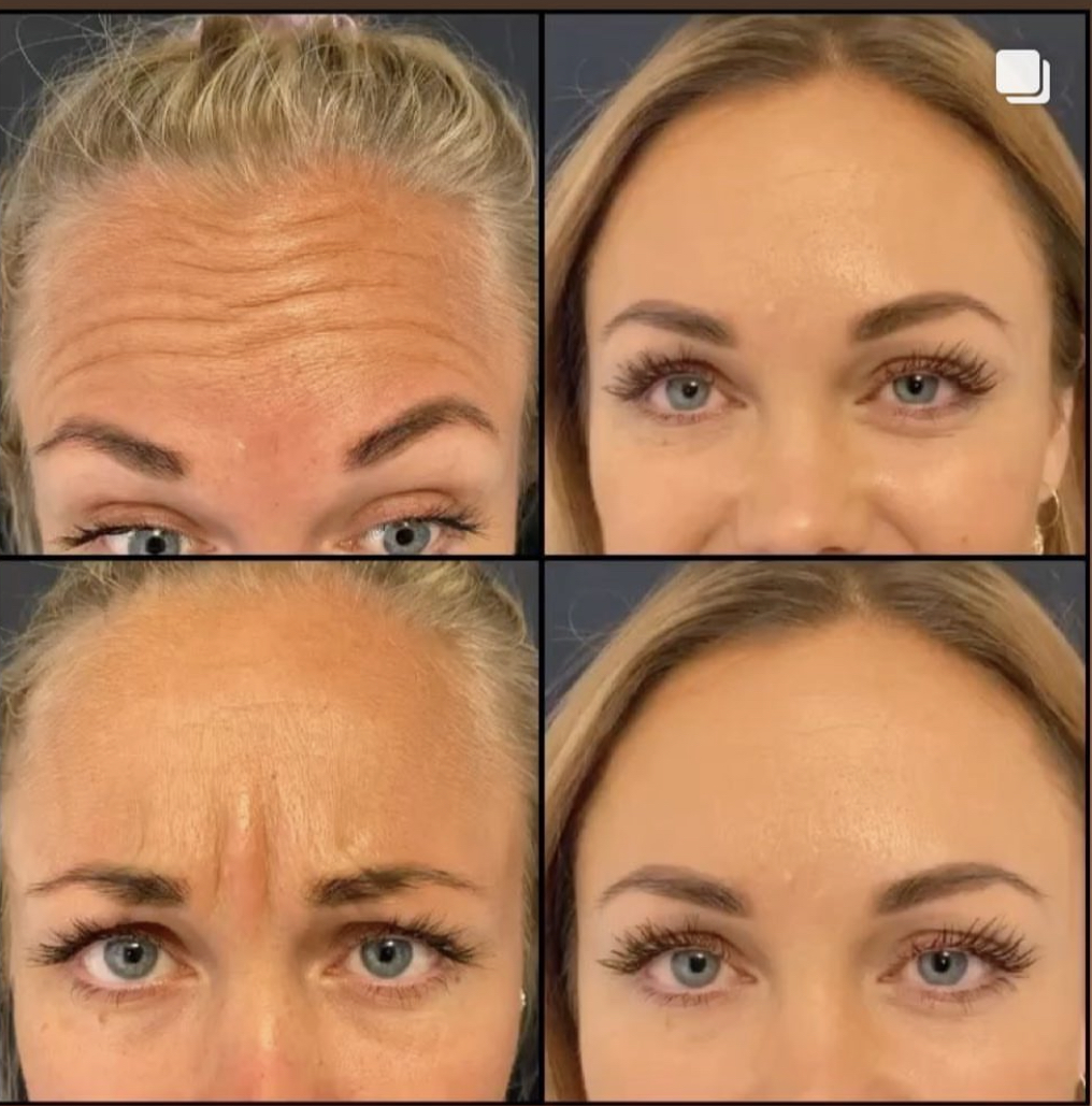 Botox Sandviken T.ESTETIK